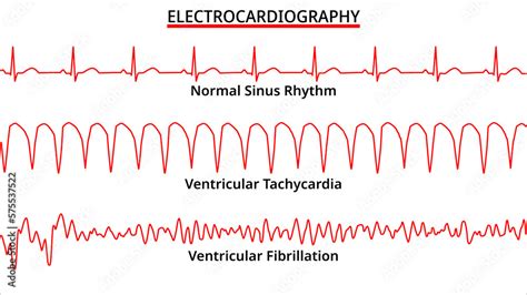 ecg porn|ECG